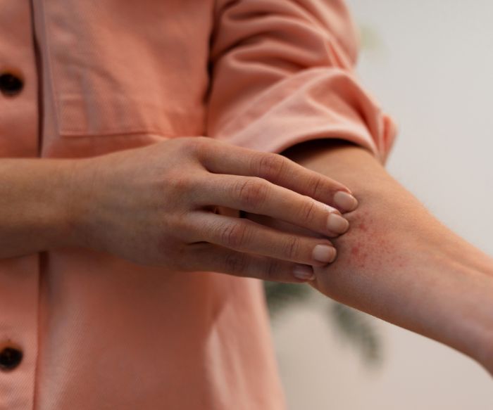 Dermatitida: Příčiny, druhy a léčba